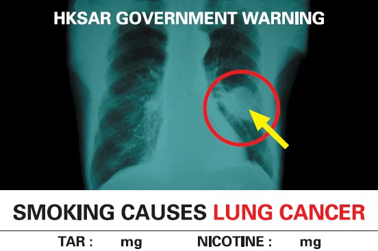 Hong Kong 2007 Health Effects lung - internal image, lung cancer, english